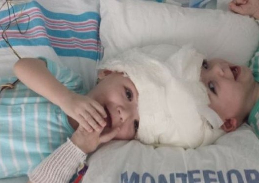 Лекари в Ню Йорк разделиха сиамски близнаци