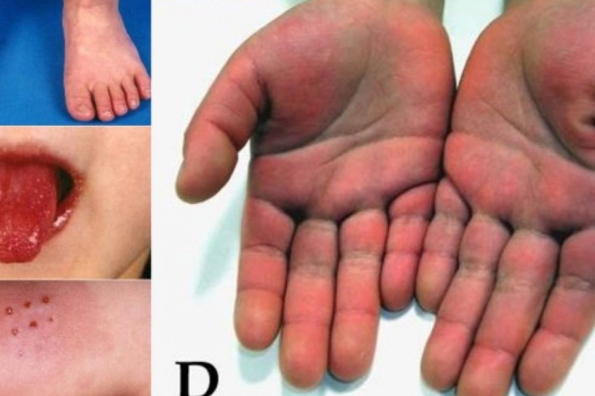 Опасно! Нова мистериозна болест удря децата във Великобритания