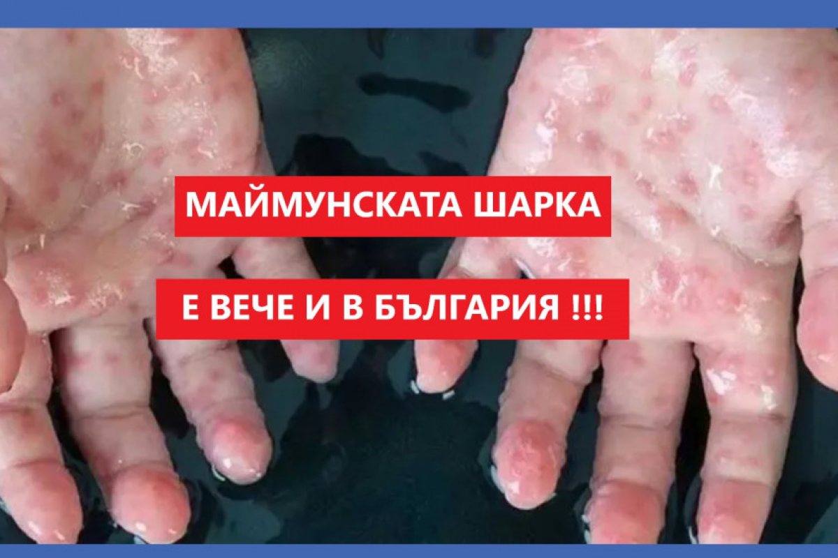Пренесоха маймунската шарка и у нас, единият заразен е пристигнал от Великобритания 