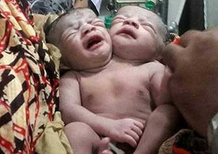Бебе с две глави се роди в Бангладеш (СНИМКА)