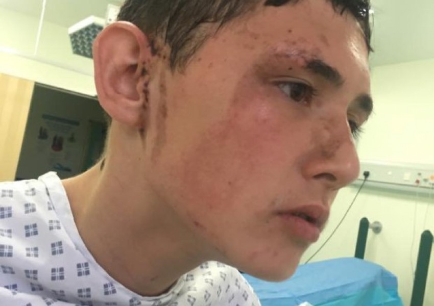 Момче се бори за зрението си след заливане с киселина