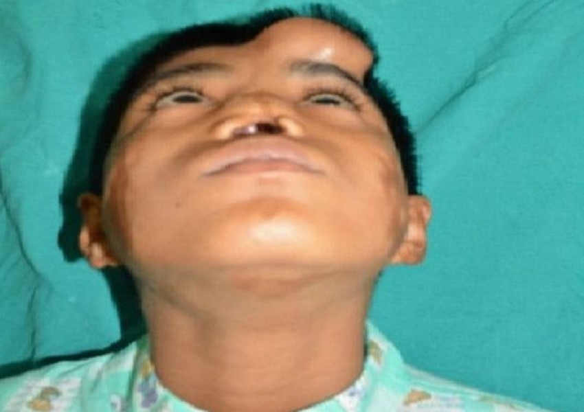 Индийски лекари отгледаха нос върху лицето на пациент