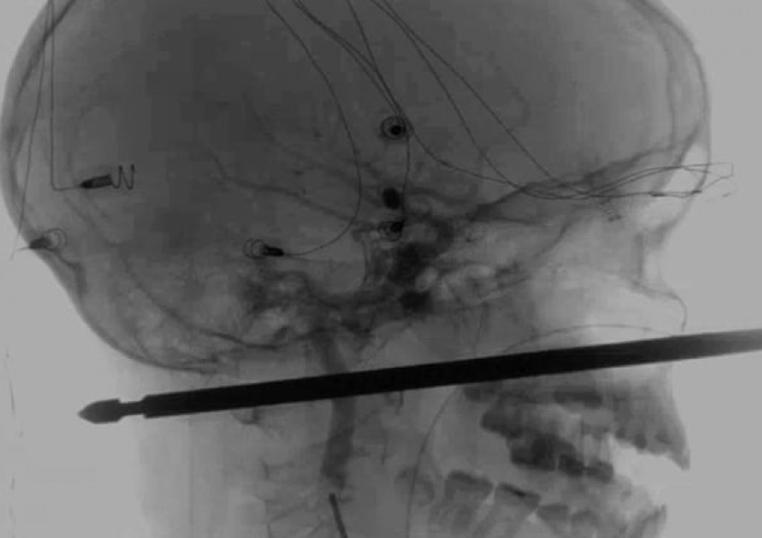 Шиш мина през главата на американче, то оцеля