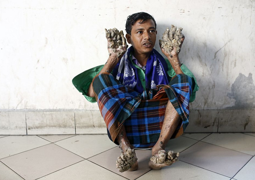 Човекът-дърво от Бангладеш ще бъде опериран отново