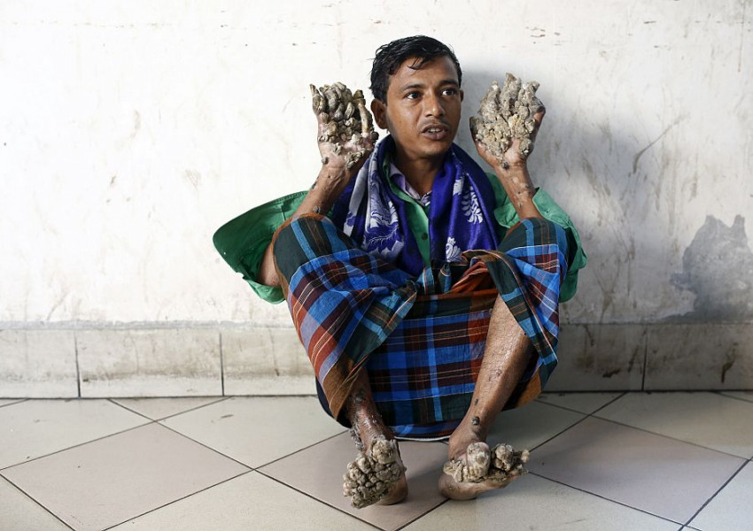 Човекът-дърво от Бангладеш ще бъде опериран отново