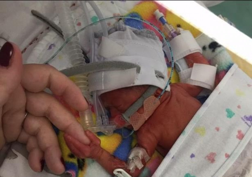 Чудо! Бебе от едва 400 грама оцеля тежка операция!