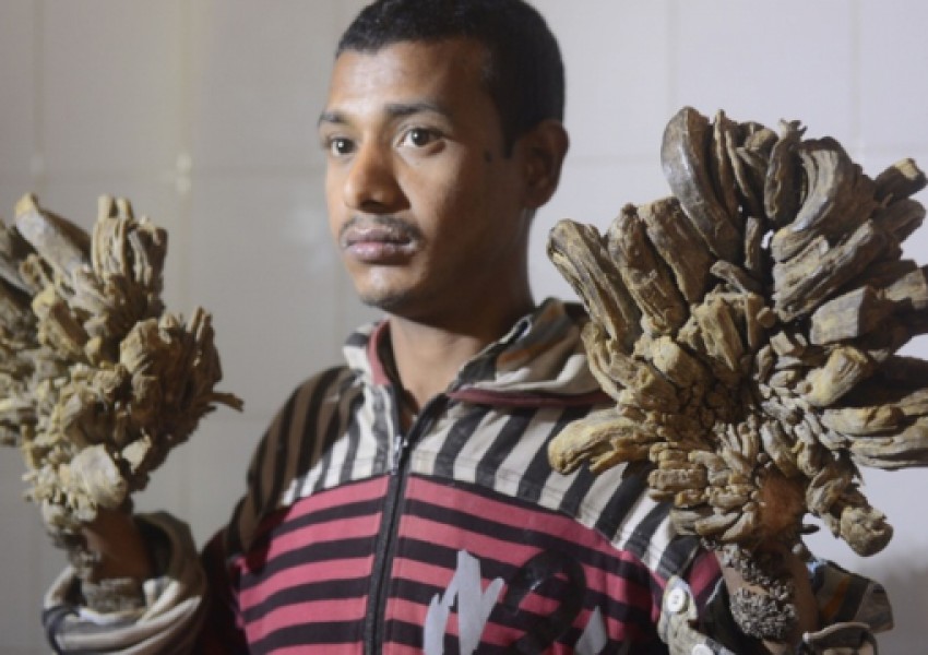 Оперираха успешно "Човека-дърво" от Бангладеш
