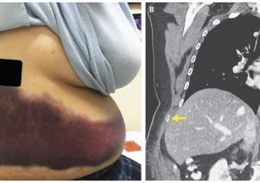 Жена кашляла така силно, че счупила ребро