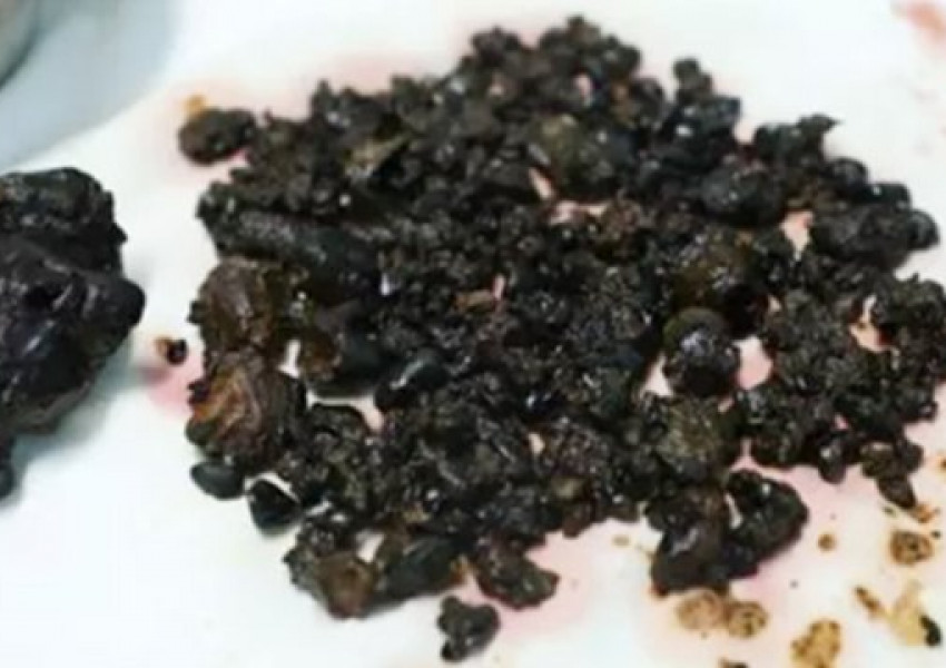 Повече от 200 камъни изкарани от тялото на жена