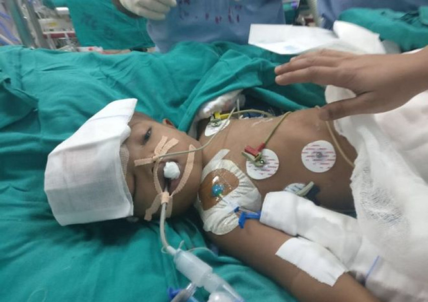 Уникална операция! Разделиха сиамски близнаци