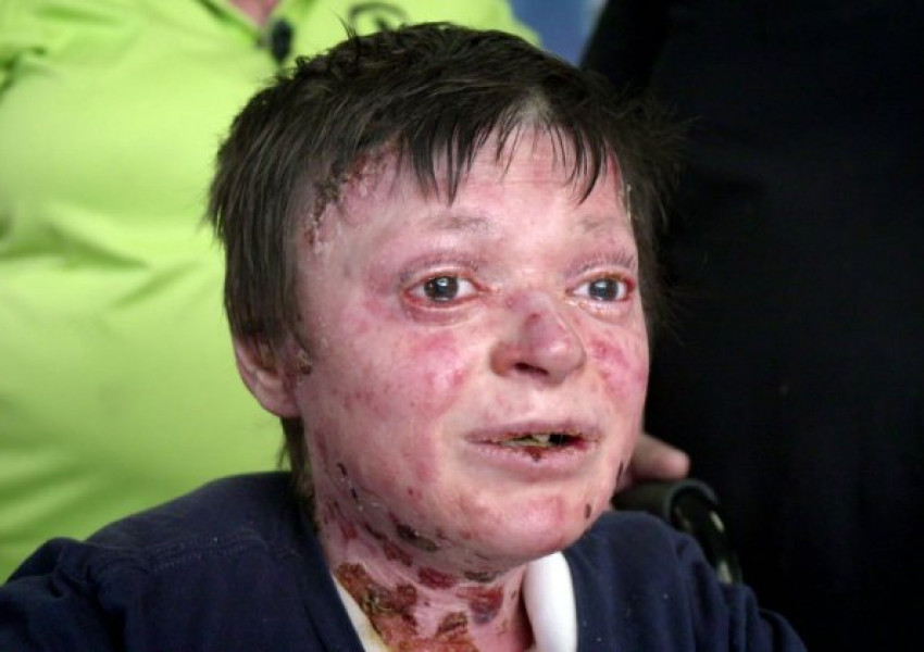 Момче без кожа се страхува да бъде лекувано