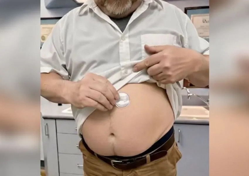 Внимание онлайн измама: Фалшиви лондонски "лекари" рекламират лепенки за отслабване в TikTok и Facebook