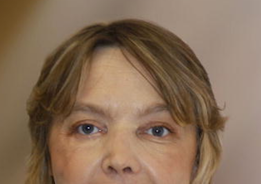 Първата жена с присадено лице в света почина 