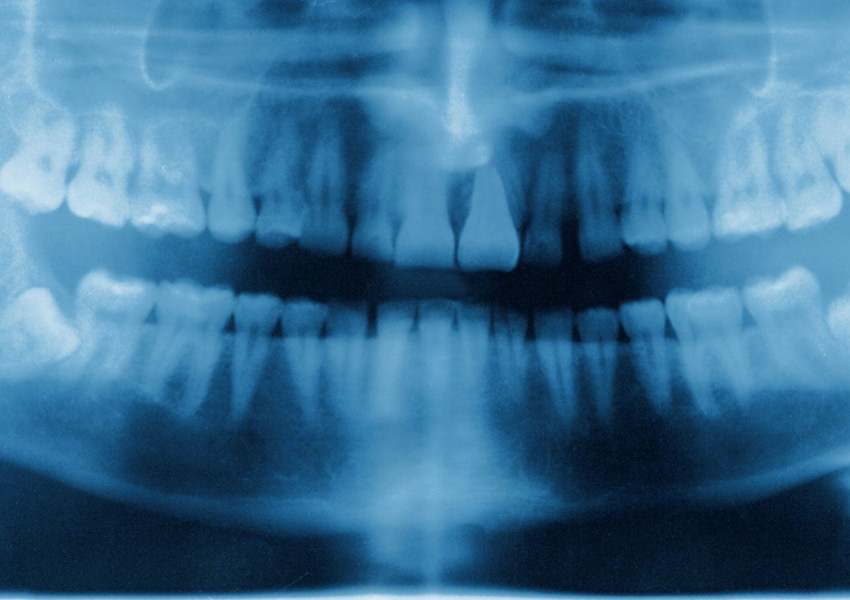 Скай: Британци „вадят сами зъбите си с клещи“, защото нямат достъп до зъболекари работещи с "NHS"